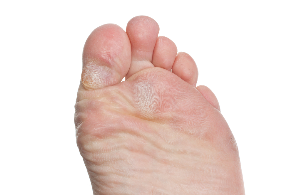 Corns and calluses on bottom of feet best sale