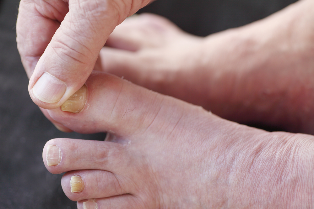 11 tips to avoid toenail fungus: Easy to catch, hard to kill - WHYY