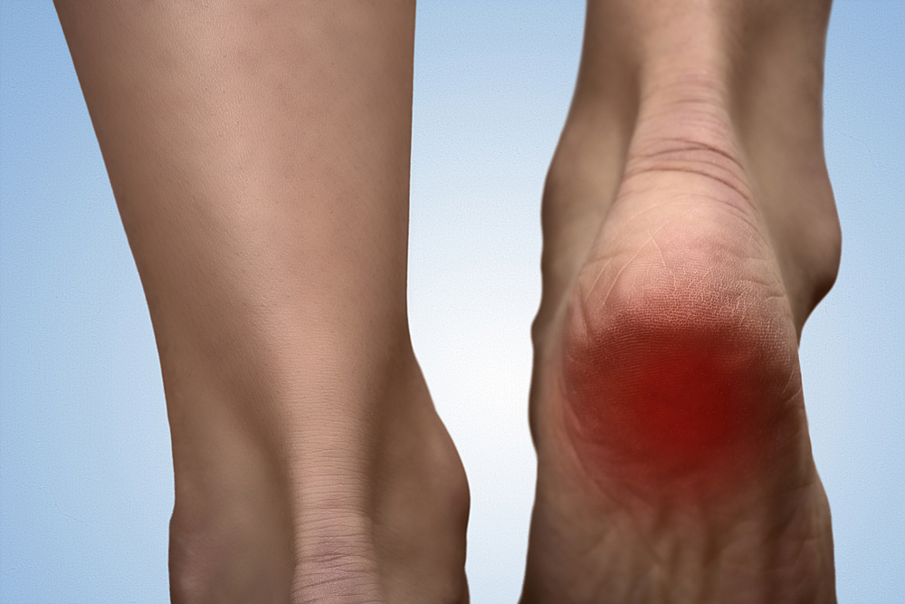 Heel Pain When Walking Find Treatment Today Island Foot Clinics