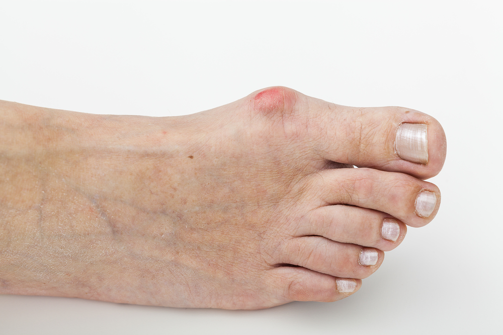 How Can You Fix Bunions Without Surgery? - Island Foot Clinics