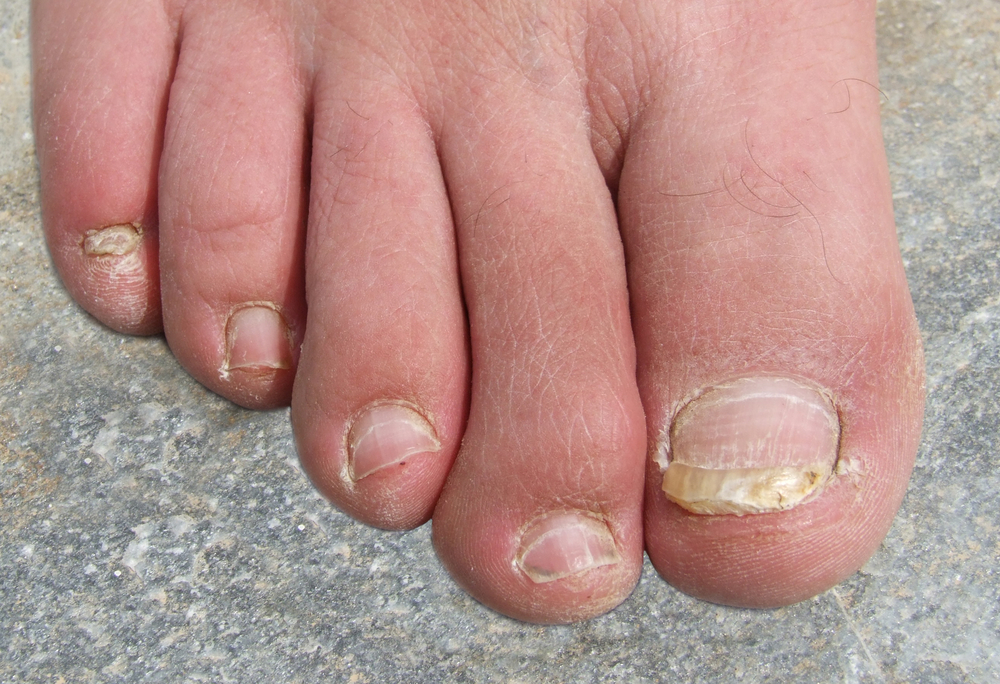 Ask a Foot Doctor What Causes Thick or Discolored Toenails? Island