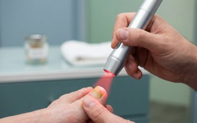 The Fungal Battle: How Cold Laser Treatments in Surrey Outperform Generic Remedies